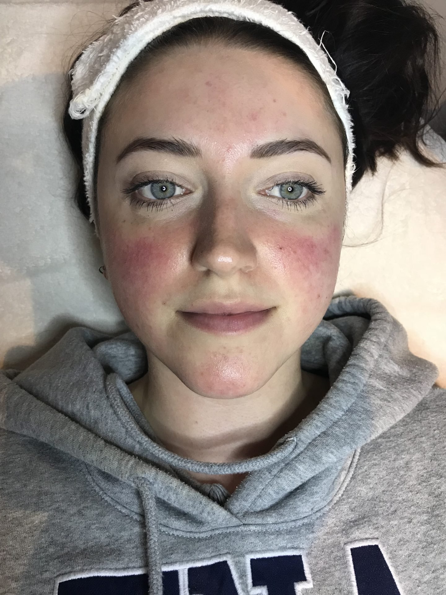 Connecticut Rosacea Treatment